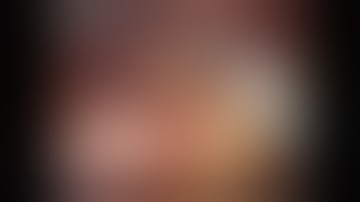 Robotic Gastric Wedge Resection