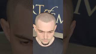 Looking to fill your corners in? Scalp Micropigmentation is your Answer!