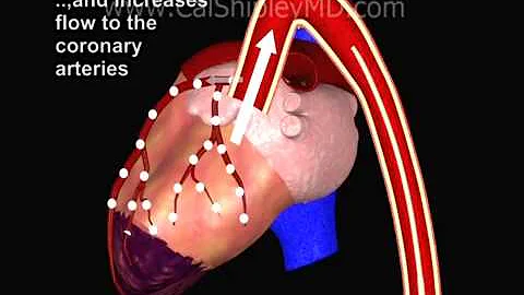 Cardiogenic Shock and Intra-aortic Balloon Pump by...