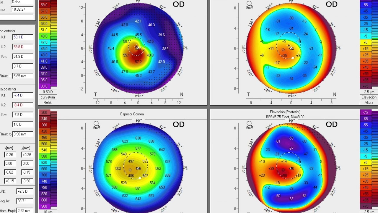 Tres parámetros topográficos contraindican las lentes intraoculares multifocales. Bonafonte