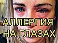 АЛЛЕРГИЯ ПРИ НАРАЩИВАНИЕ РЕСНИЦ.ПИСЬМЕННОЕ СОГЛАСИЕ КЛИЕНТА.КОРРЕКЦИЯ ИЛИ ПЕРЕНАРАЩИВАНИЕ.ЧТО ЛУЧШЕ?