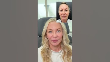 1.5 Years Post-Op From Full Face Rejuvenation 😱 #beforeandafter