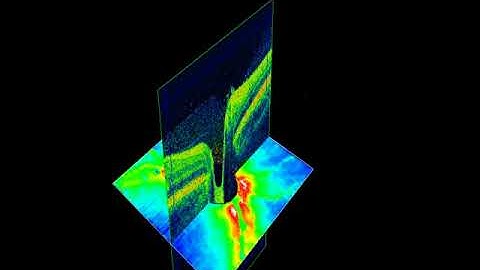 Optic Nerve Slicing with RNFL Thickness Map