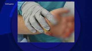Some states treating people with serious burns as dangerous heat continues across US