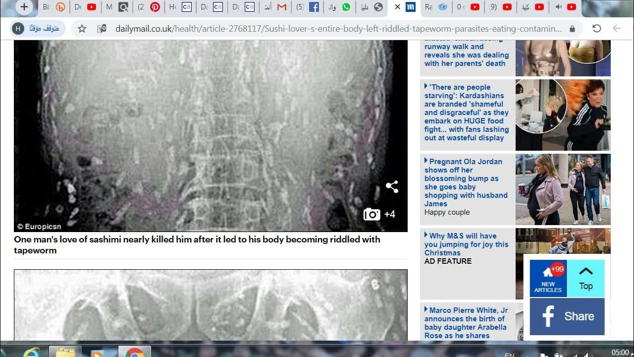 Sushi Lover's Entire Body Left Riddled With WORMS After Eating