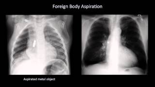 Full How to Interpret a Chest X Ray Lesson 4   Airways, Bones, and Soft Tissues Guide