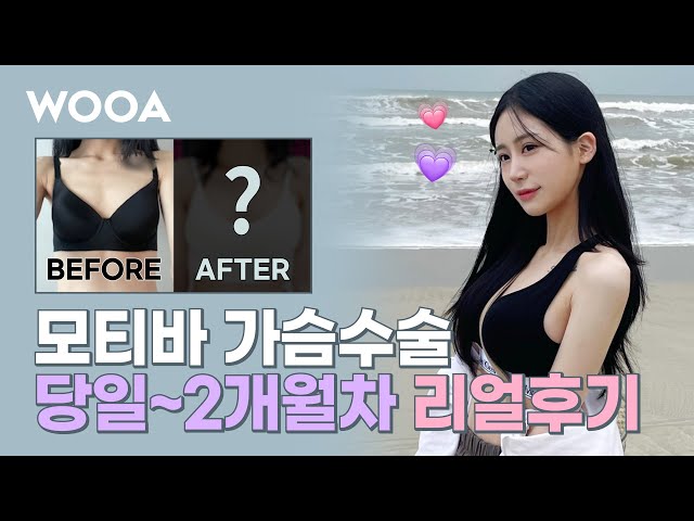 [ 가슴수술후기 ] 모티바 가슴수술 당일~2개월차 리얼후기!!