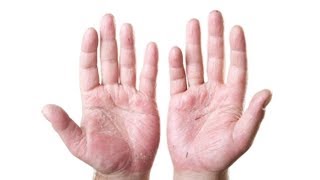 ऊँगली की खाल उतरने पर अपनाएं ये घरेलु नुस्खे || Indian Health Tips 4 U | घरेलु उपचार screenshot 3