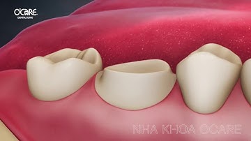 Bọc răng sứ cho răng sâu như thế nào?