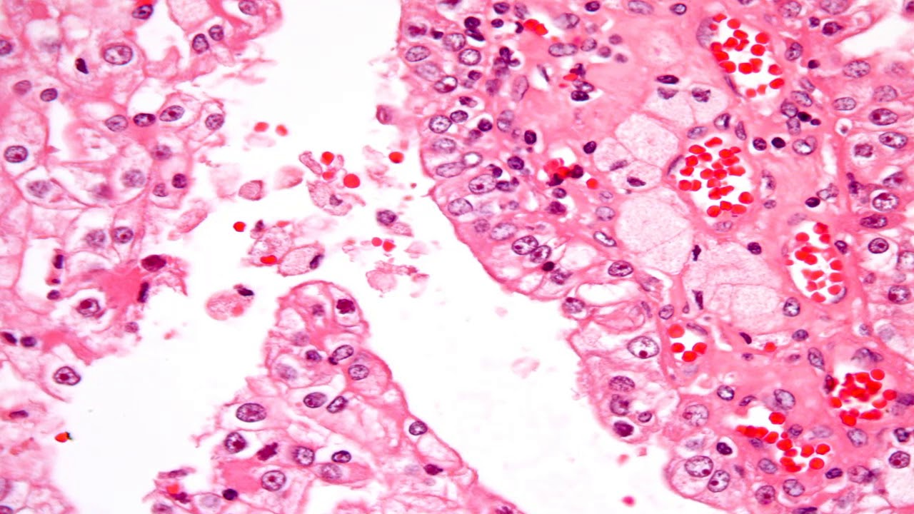 Stage 4 Renal Cell Carcinoma Metastasis Survival Rates And Treatment Stage 4 Renal Cell Carcinoma Metastasis Survival Rates And Treatment