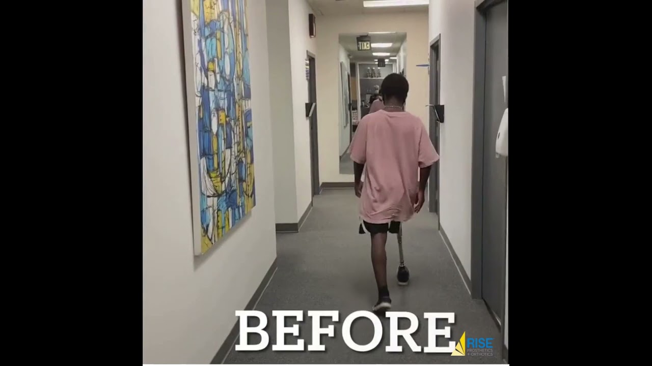 Gadson recently received his first microprocessor knee.