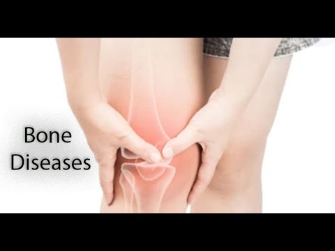 The 4 Most Common Bone Diseases
