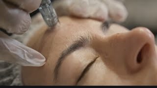 Microneedling Facts