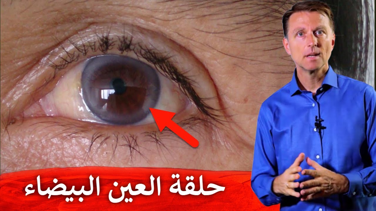 حلقة بيضاء حول عدسة العين