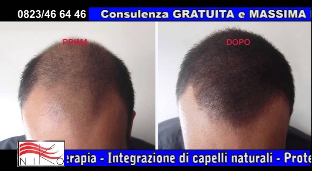 Protesi capelli a/in Caserta;centro per calvizie Caserta