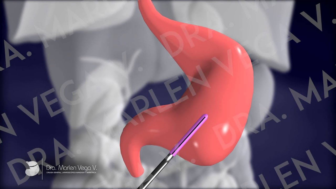 Dra. Vega: Cirugía Bariátrica/Manga Gástrica - Video animado