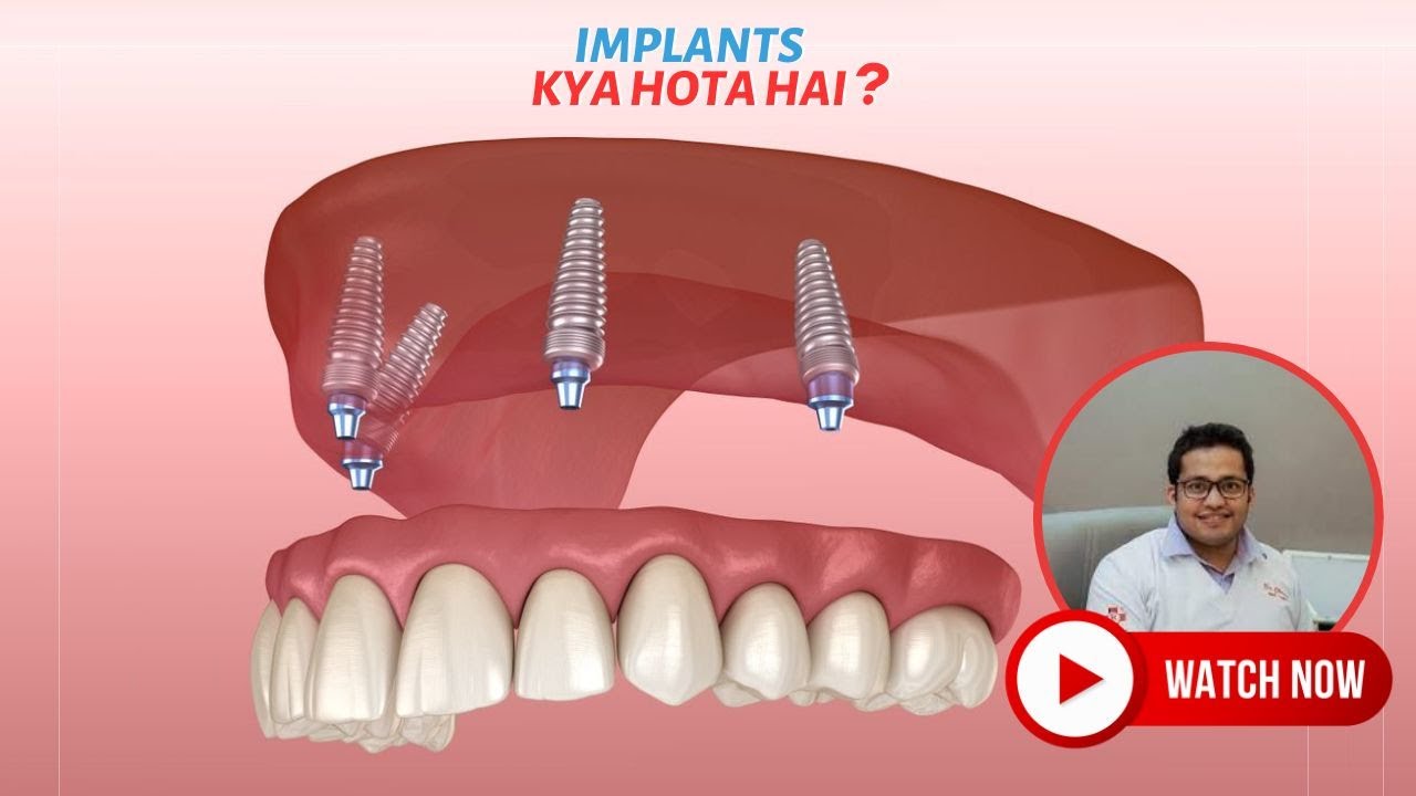 Implants Kya Hota Hai? इम्प्लांट्स क्या होता है? Dental Insights by Dr
