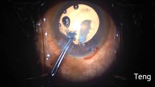 Phacoantigenic Glaucoma, Soft Cataract Extraction. Chris Teng, MD screenshot 1