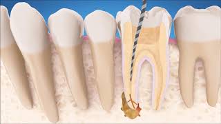 Are Root Canals Safe? - Dr. Russell gives a great perspective