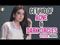 How To Get Rid Of Acne And Dark Circles? | Yashma Gil | SU1