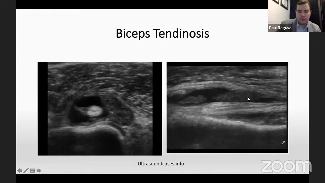 Ультразвуковое исследование плеча