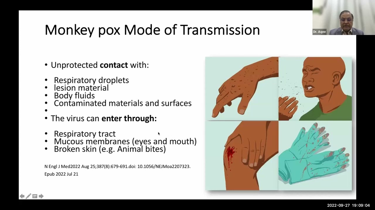 All you need to know about Monkeypox 