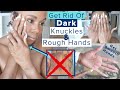 Get Rid of Dark Knuckles & ROUGH Hands | No More Hyperpigmentation, Dry Hands & Acanthosis Nigricans