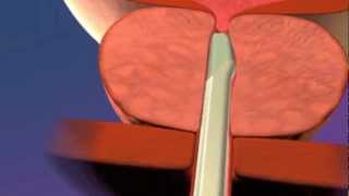 The UroLift System Animation