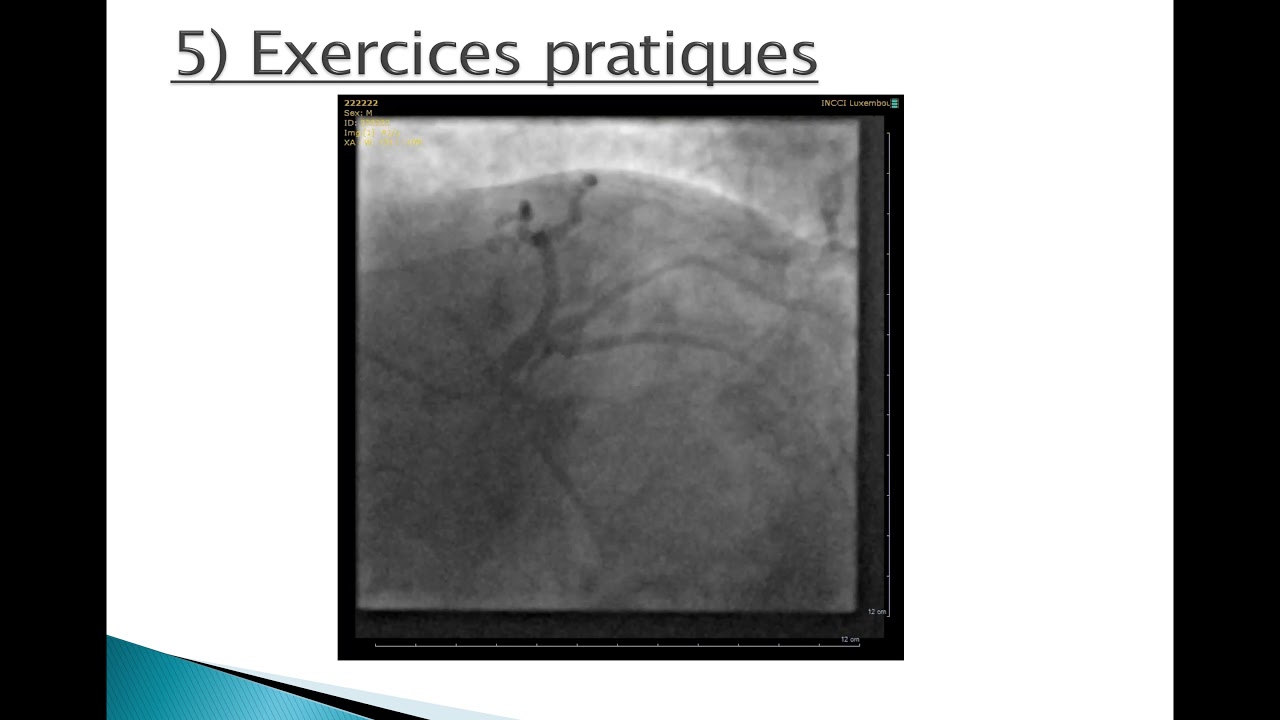 AsPeCaF 2019 - Exposé 10 - Tommy SGUERA : Incidences radiologiques en coro (exercices pratiques)
