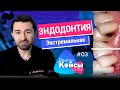 Экстремальная эндодонтия и сложная реставрация. Дентал Кейсы от BG. #03