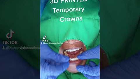 3D PRINTED TEMPORARY CROWNS