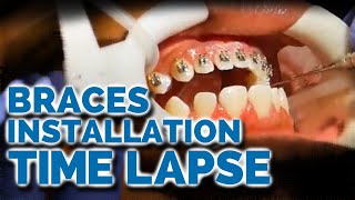 Braces Installation Time Lapse: What to expect when getting braces