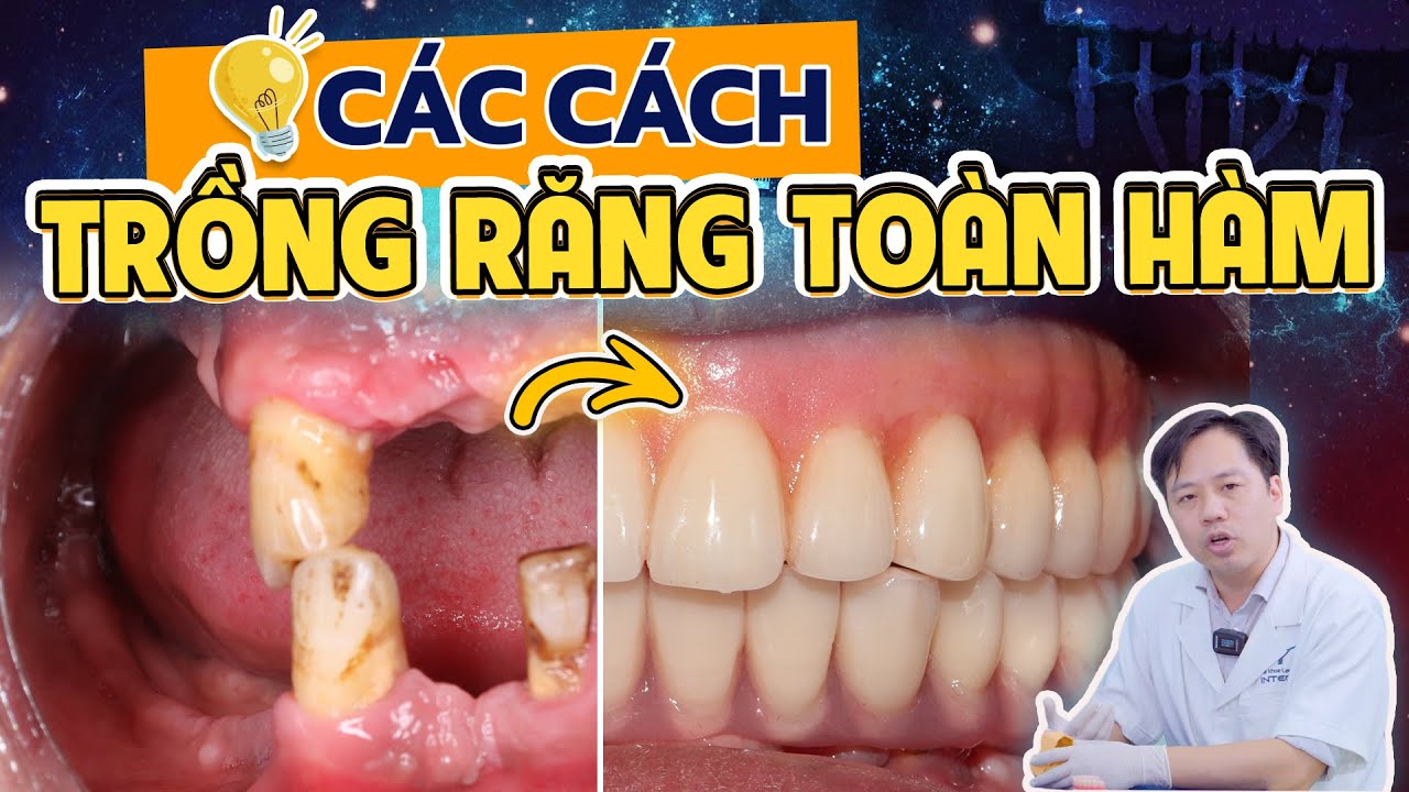 Outline Video Các Phương Pháp Trồng Răng Toàn Hàm? Nên Chọn Hàm Tháo Lắp Hay Implant Toàn Hàm Cố Định?