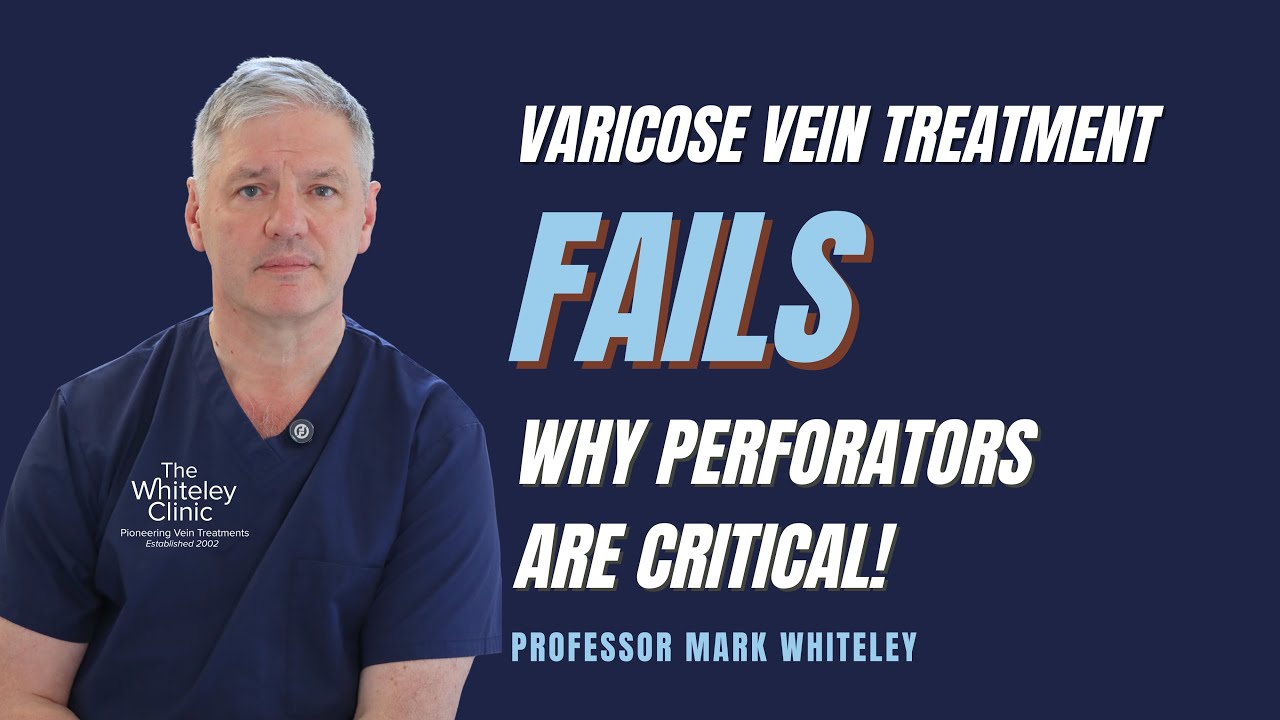 Лечение варикозного расширения вен неэффективно: почему перфораторные вены играют решающую роль!