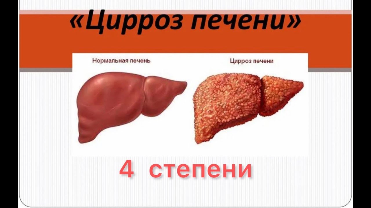 Цирроз печени 4 степени Vertera Gel Ламинария - YouTube