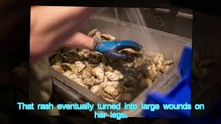 HEALTH SHELLFISH Woman Dies From Flesh-Eating Bacteria After Eating Raw Oysters