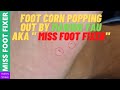 SATISFYING FOOT CORNS POPPING OUT BY Miss Foot Fixer