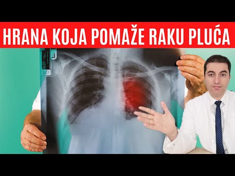 Video: 4 načina za ublažavanje bolova u više mijeloma