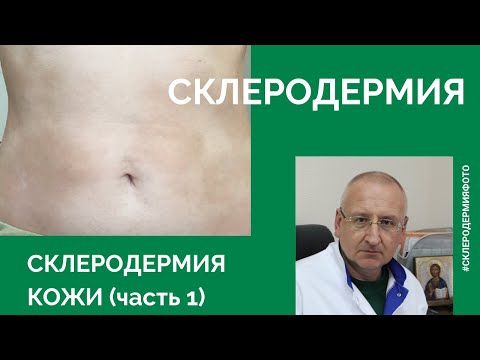 Склеродермия. Склеродермия кожи. Склеродермия фото. Очаговая склеродермия. (часть 1)
