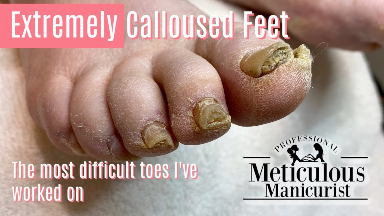 Toe Nail Fungus, Barefoot Running Blood Blisters, and Toe Socks