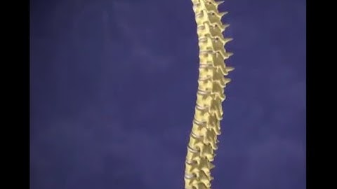Kyphoplasty Spinal Fracture (Animation)