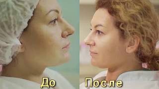 отзыв Наноазия До и После Nanoasia. Мезотерапия без инъекций отзыв Наноазия До и После Nanoasia. Мезотерапия без инъекций