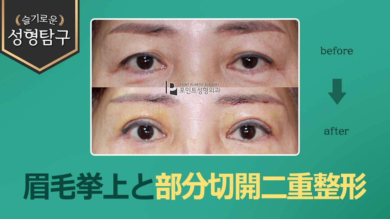 Korean Double Eyelid Surgery] Eliminating Saggy Eyelids: Subbrow