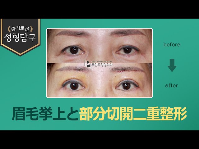 Korean Double Eyelid Surgery] Eliminating Saggy Eyelids: Subbrow