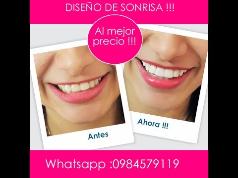 Diseno De Sonrisa Quito Www Bucanova Com Youtube