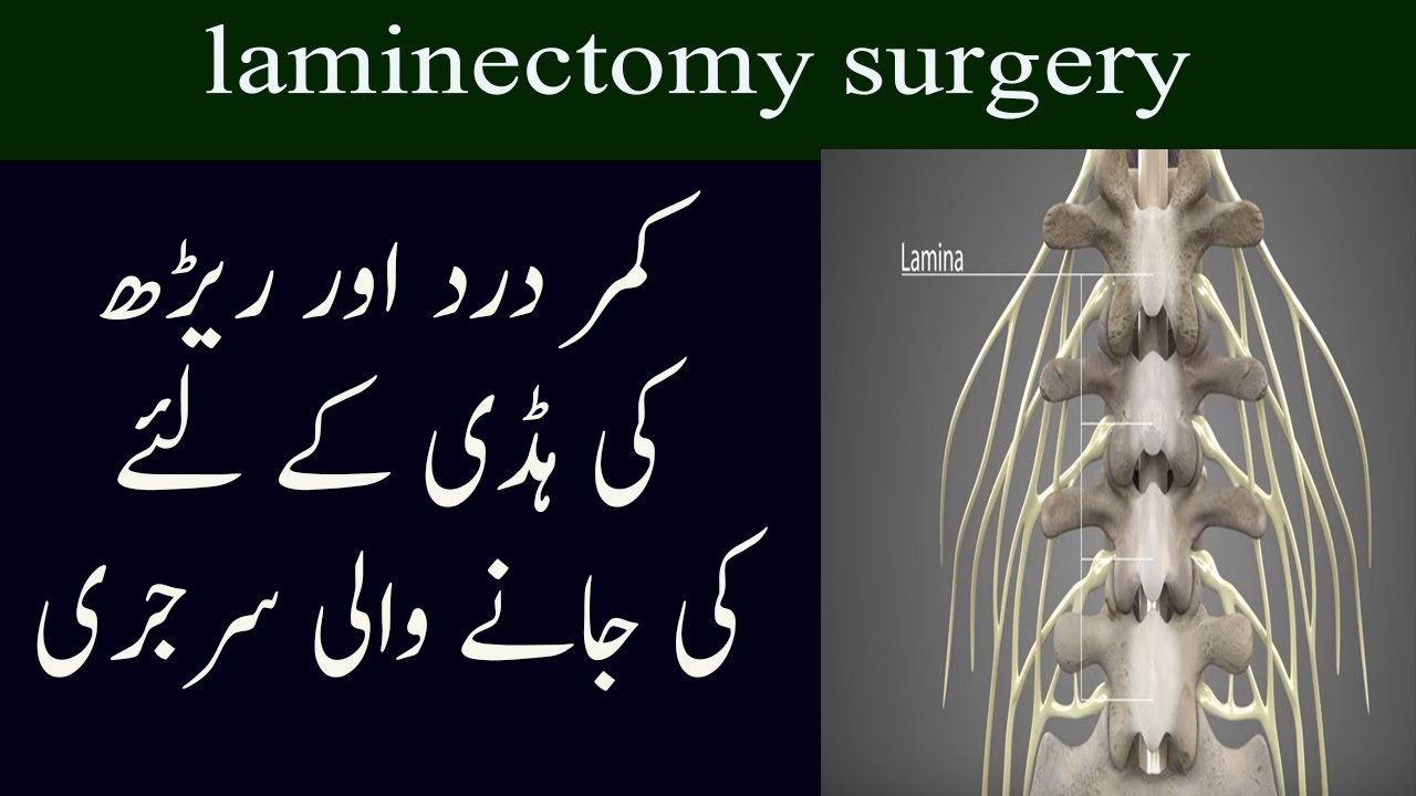 What Is A Lumbar Cervical And Laminectomy Surgery In Urdu