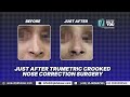 Secondary Rhinoplasty | Crooked Nose Correction | टेढ़ी नाक का दोबारा सुधार | By Dr. PK Talwar
