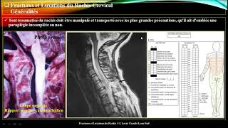 Traumatisme du rachis cervical ? meilleure explication ? par Pr Atia