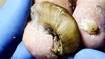 Wow, Onychomycosis Looks Like A Slide, Perfect Solution【Podiatry Clinic】