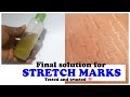 Remove tough stretch marks with this serum | DIY STRETCH MARKS REMOVAL| prime side.